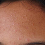 fungal acne vs closed comedones