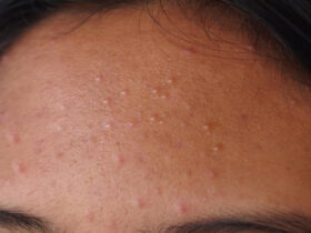 fungal acne vs closed comedones